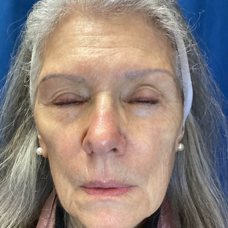 After treatment