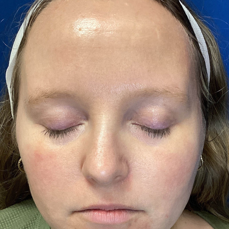 After treatment