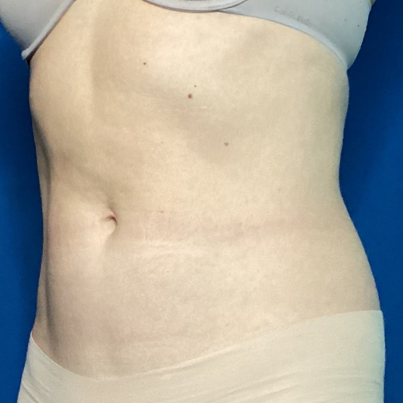 After treatment