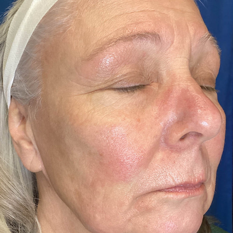 After treatment